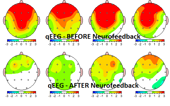What is a QEEG Brain Map?
